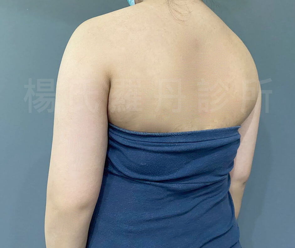 雷射減脂 楊氏羅丹 瘦手臂  抽脂推薦